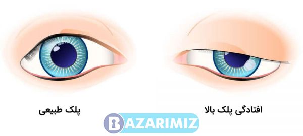 دکتر آرش طلوع مهر رفع افتادگی پلک بالا در ارومیه بلفاروپلاستی